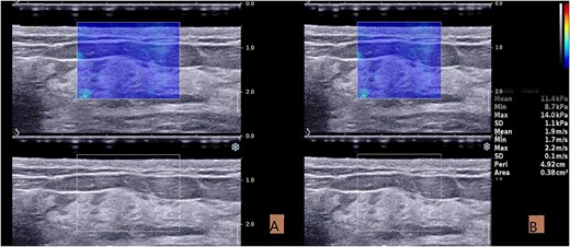 Acquisition and measurement of ultrasound images. (A) The SWE image taken in the resting state. (B) Measurement of elastic modulus in SWE mode. The skin boundary is traced manually to measure the elastic value of the entire skin layer.