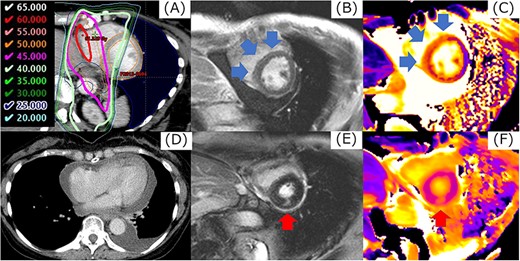 The example in cardiac event of Grade 4. Corresponding regions of 40 Gy or more (A), LGE by magnetic resonance imaging were detected in the mid-myocardial layer in the base of the LV (B). The value of native T1 in this region increased from 1168 ms before CRT to 1269 ms (C). At 53.7 months after CRT, the patient had pericardial effusion with cardiac tamponade (D). When CMR imaging was performed at the diagnosis of cardiac tamponade, a new LGE at a margin of dose distribution of 45 Gy was observed in the mid-myocardial layer in the base of the LV, separately from the LGE identified 6 months after CRT (E, F). Cardiac catheterization revealed constrictive pericarditis, and a pericardial incision was made.