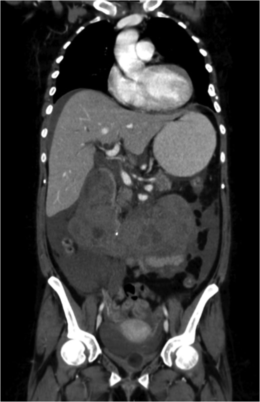 A coronal section of a venous phase abdominal CT demonstrating the end of the IVC filter strut penetrating the wall of the third part of the duodenum.