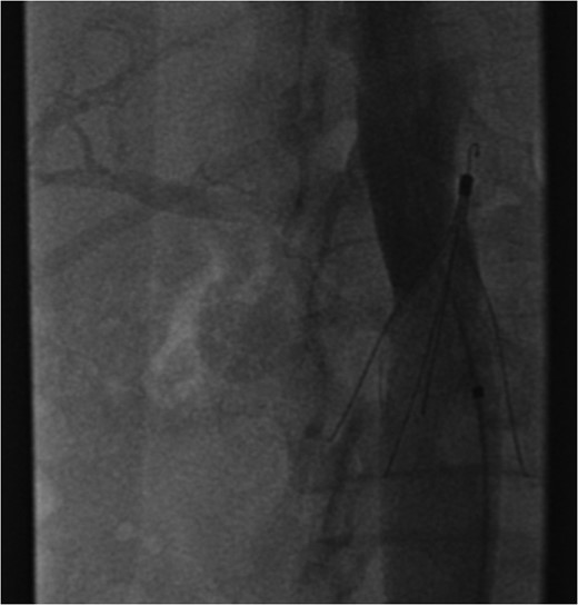 Excessive tilting of the IVC filter causes the hook of the filter to appear outside of the lumen of the IVC.