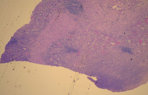 Micrograph of resected colon. Histopathologic analysis showing necrotic colon with transmural necrosis. Hematoxylin and eosin stain.