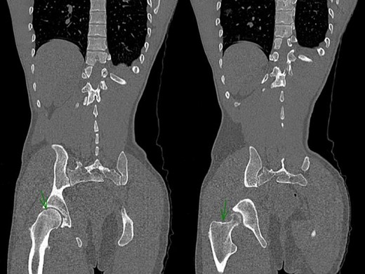 Post-reduction CT-Scan of the pelvis showing a non-displaced fracture of the head of the femur and a non-displaced inter-trochanteric fracture of the right hip.