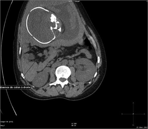 Abdominal-Pelvic CT-scan, non-contrast enhanced, in the sagittal plan, eleventh dorsal vertebra level.