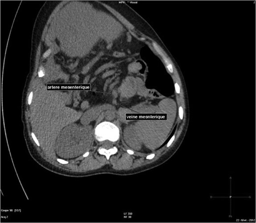 Abdominal-pelvic CT-scan, non-contrast enhanced, in the sagittal plane.