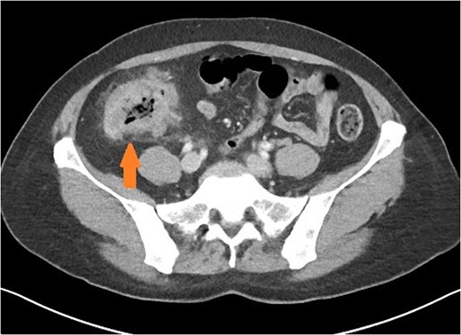 Axial view of patient with caecal carcinoma. Eccentric caecal wall thickening with homogenous contrast enhancement (arrow). Mild pericolic fat stranding is present.