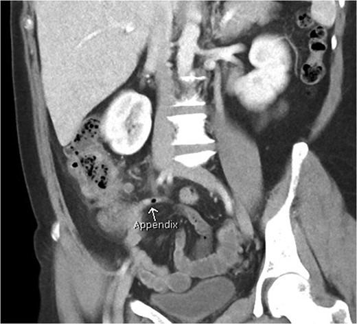 Coronal view of patient with caecal carcinoma. Normal (non-dilated) appendix (arrow).