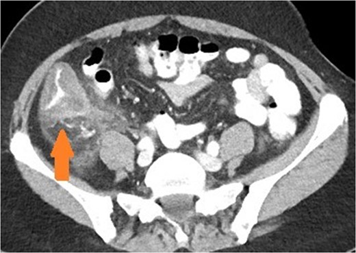Axial view of patient with appendicitis. Eccentric caecal wall thickening (maximal surrounding the appendiceal orifice) with layered mural contrast enhancement secondary to prominent submucosal oedema (arrow) and prominent pericolic fat stranding represent the CT manifestation of the surgical phlegmon.