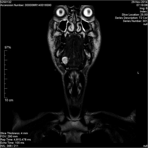 Coronal T2-weighted image. L, lesion; m, mylohyoid muscle; sm, submandibular gland; ad, anterior belly of digastric muscle.