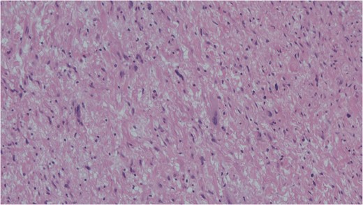 Cells with enlarged hyperchromatic nuclei seen in ancient schwannoma. Haemotoxylin and eosin (H&E).