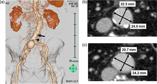 a. Preoperative CT image with three-dimensional reconstruction showing isolated saccular-type, right common iliac artery aneurysm. b. Preoperative axial CT image at the level of black arrow shows relatively narrow abdominal aorta (24.0 × 22.5 cm) approximately 2.5 cm above the level of the terminal aorta. c. Preoperative axial CT image at the level of the black arrow head shows relatively narrow terminal aorta (24.2 × 20.7 cm). CT, computed tomography.