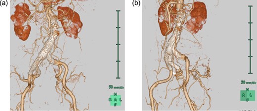 CT images with three-dimensional reconstruction 1 year after endovascular aortic repair. a. Anteroposterior view shows a patent right internal iliac artery without leakage. b. Left anterior oblique view shows the alleviated compression of the contralateral leg in the terminal aorta. CT, computed tomography.