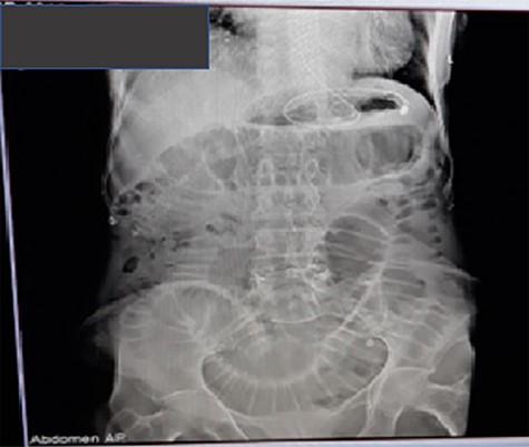 Plain abdominal X-ray showing dilated small bowel loops with visible valvulae conniventes.