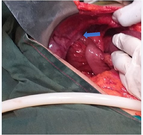 Intraoperative picture showing herniated small bowel through the left obturator foramen.