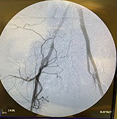 Fluoroscopy of right iliac artery showing vast collateral vascular formation, indicating long-standing proximal obstruction.