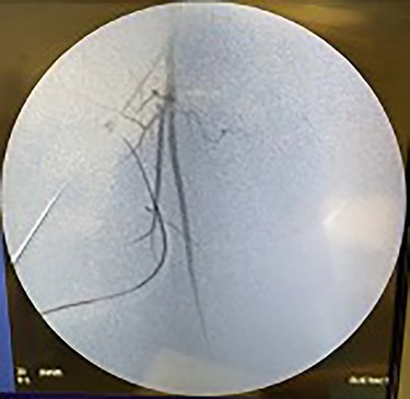 Fluoroscopy of left iliac artery showing improved perfusion.