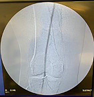 Fluoroscopy of left popliteal artery showing good perfusion.