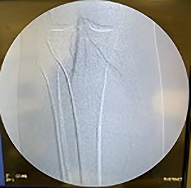 Fluoroscopy of right popliteal artery showing good perfusion.