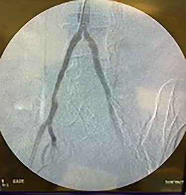 Fluoroscopy of bilateral iliac arteries showing significant arterial disease.
