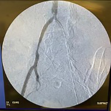 Fluoroscopy of guidewire being passed into left iliac artery.