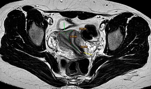 MRI pelvis, axial T2, complete separate uterine cavity (complete septate uterus), two cervices openings (below arrow), no fundal cleft, inter-cornual distance = 29.5 mm (above arrow), the upper 23.5 mm of the septum is composed of myometrium, while the distal 28 mm is composed of fibrous tissue.