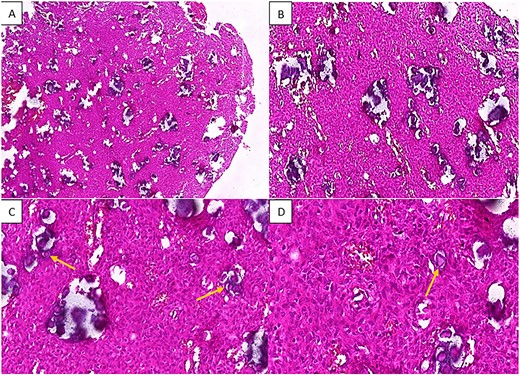 H&E staining of the pathological specimen at different magnifications shows a benign fibro-osseous proliferation characterized by a large number of spherical basophilic calcified entities with no osteoblastic rimming resembling psammoma bodies (arrowheads), within a fibroblastic stroma of uniform stellate or spindle-shaped cells; (A and B) low power magnifications; (C) x20 power magnification; (D) high power (x40) magnification.