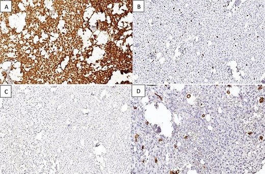 Immunostaining reveals that the tumor tissue is (A) diffusely positive for Vimentin in the stromal component; (B) low Ki-67 proliferation index; (C and D) negative staining for EMA and CD34.