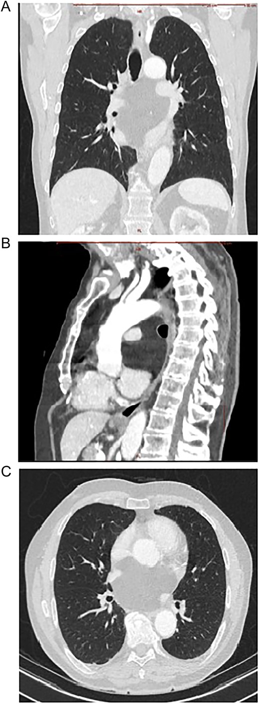 Contrast enhanced CT scan of mediastinum demonstrating the well-defined focal fat-attenuated homogenous lesion. (A) Coronal view, (B) sagittal view, (C)axial view.
