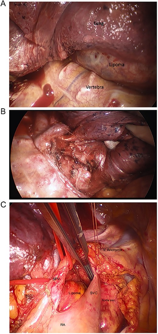 Intraoperative images. (A) After thoracotomy giving access to mediastinum, (B) incision in posterior mediastinal pleura giving access to posterior mediastinum, (C) separating lipoma around SVC, superior pulmonary vein (SPV), ascending aorta, right atrium (RA), hidden pulmonary truncus, and right pulmonary artery.