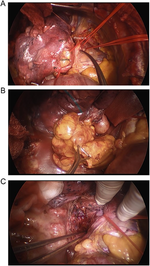 Intraoperative images. (A) Intraoperative view of inferior pulmonary vein (IPV), SPV, phrenic nerve, right atrium, and the lipoma, (B) final removal of the Lipoma from the right incision of the dorsal mediastinum, (C) resection site after removal of lipoma before closure.