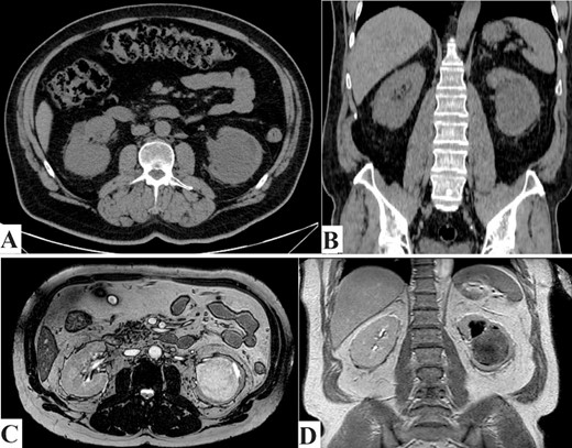(A) CT scan axial section and (B) CT scan coronal section. Showing left kidney well-defined rounded soft tissue density mass lesions measuring about 6.7 cm in the lower aspect of the renal medulla. (C) MRI axial section, and (D) MRI coronal section. Showing left kidney large well defined rounded hypointense on T1W and heterogenous hyperintense on T2W images focus seen in the lower aspect of the medulla of the left kidney measuring about 6.8 cm approximately, resulting in mild calyceal dilatation.