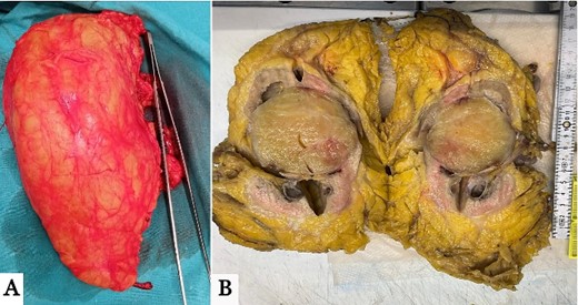 (A) Gross images of the harvested left kidney with the tumor located in the lower pole. (B) Cross-section of the harvested specimen showing a well-demarcated circumscribed mass located inside renal parenchyma at the lower aspect of the left renal medulla.