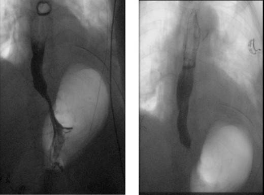 Normal X-ray esophagram fluoroscopy postdiverticulectomy with myotomy surgery.