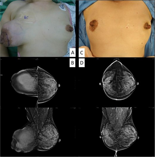 The clinical picture and mammography before (A, B) and after (C, D) the operation.