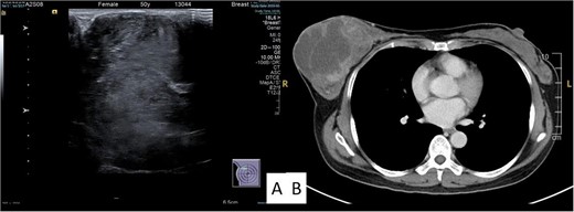 Ultrasound (A) and computed tomography (B) image of the tumor.