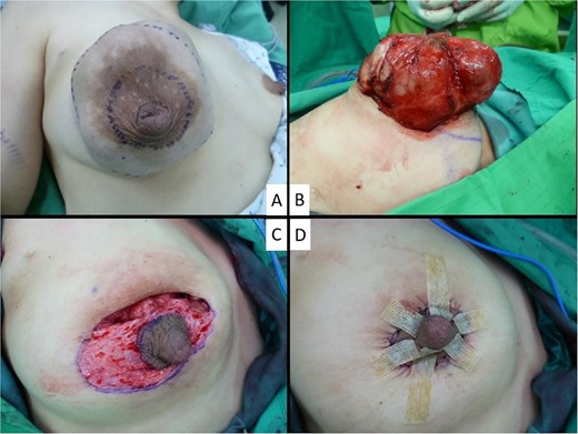 Periareolar mastopexy approach for giant phylloedes tumor.