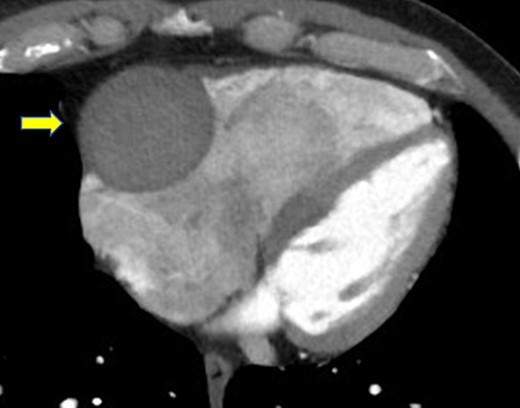 Enhanced computed tomography shows a giant coronary artery aneurysm (arrow) at the right coronary artery, which is occluded completely by a thrombus.