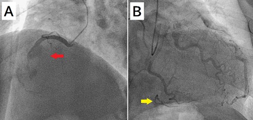 (A) Coronary angiography shows occlusion of the right coronary artery proximal to the aneurysm (arrow). (B) The artery distal to the aneurysm shows contrast via a collateral artery from the left circumflex artery (arrow).