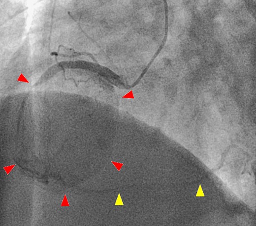 A second coronary artery angiography shows slight contrast in the aneurysm (arrow head) and in the distal coronary artery (arrow head).