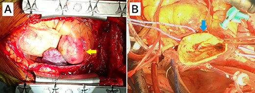 Intraoperative image from the surgeon’s perspective. (A) There is a giant coronary artery aneurysm (arrow) on the right ventricle. (B) A view of the inside of the aneurysmal sac (arrow).