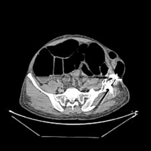 Axial abdominal CT scan.