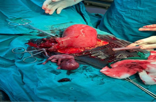 A ruptured right tubal pregnancy with an intrauterine pregnancy.