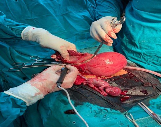 A resection of the right tubal ruptured ectopic pregnancy.