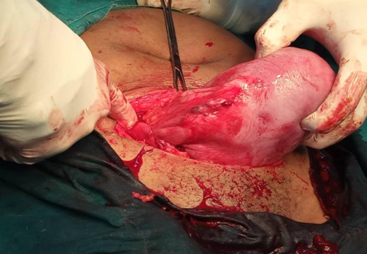 A healed right adnexa as it appears after cesarean section.