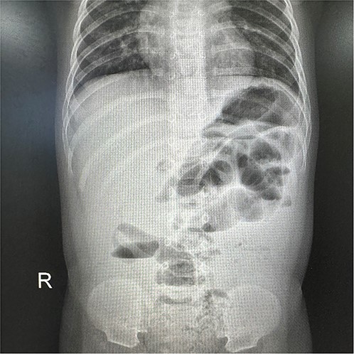 X-ray revealed partial small intestinal pneumatosis expansion alongside multiple air-fluid levels.