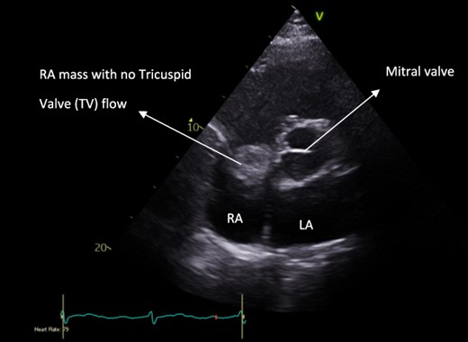 Pre-operative apical four-chamber view echocardiogram showing RA bulk blocking TV flow.