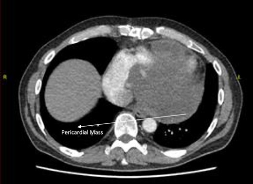 Post-operative CT scan showing pericardial mass following chemotherapy.