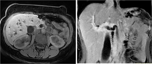 MRI in axial and sagittal views shows the location of the AOV tumor, as pointed out by the arrows.