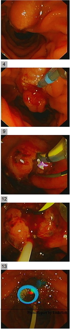 Endoscopic cannulation and location of the tumor.