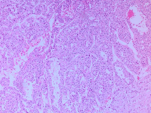 Microscopic image with H&E staining shows the tumor cells.