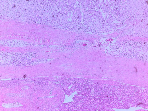 Microscopic image with H&E staining shows a tumor interface with normal liver parenchyma.